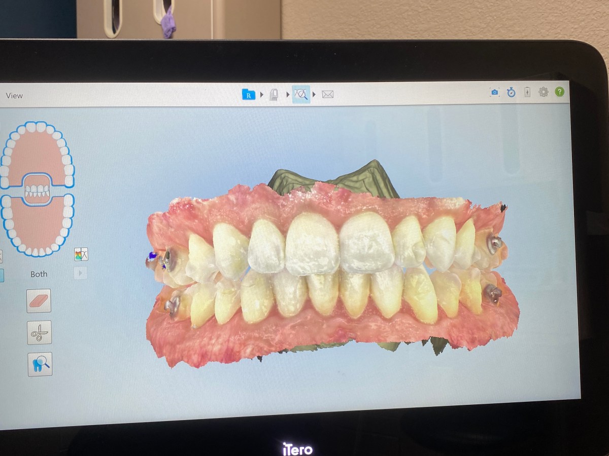 15 | 7 months post&nbsp;op